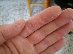 Шелушение кожи рук
